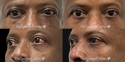 Tear Trough / Under Eye Fillers Before & After Gallery - Patient 267463 - Image 1