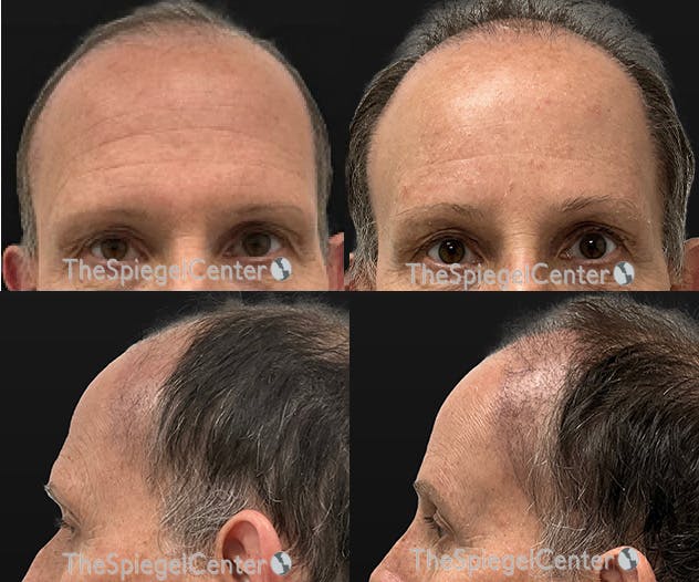 Forehead Contouring Before & After Gallery - Patient 180958 - Image 1