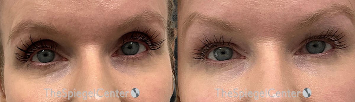 Upper Eyelid Filler Before & After Gallery - Patient 223491 - Image 1
