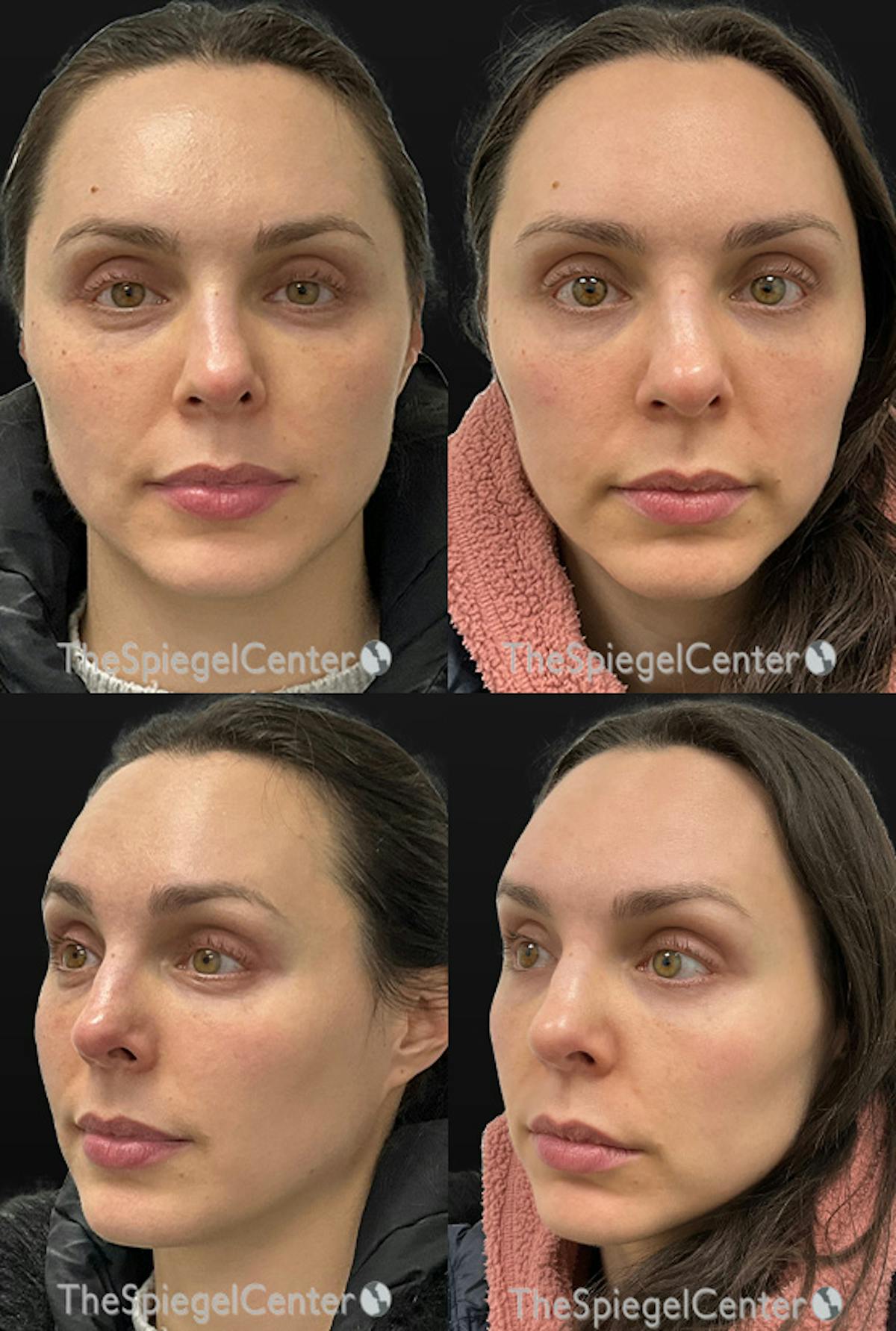 Masseter Botox Before & After Gallery - Patient 118350 - Image 1