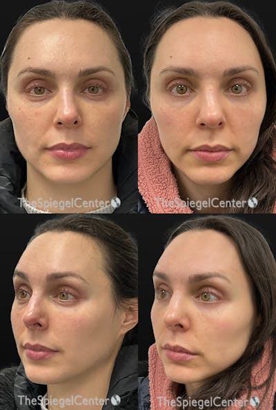 Masseter Botox Before & After Gallery - Patient 118350 - Image 1