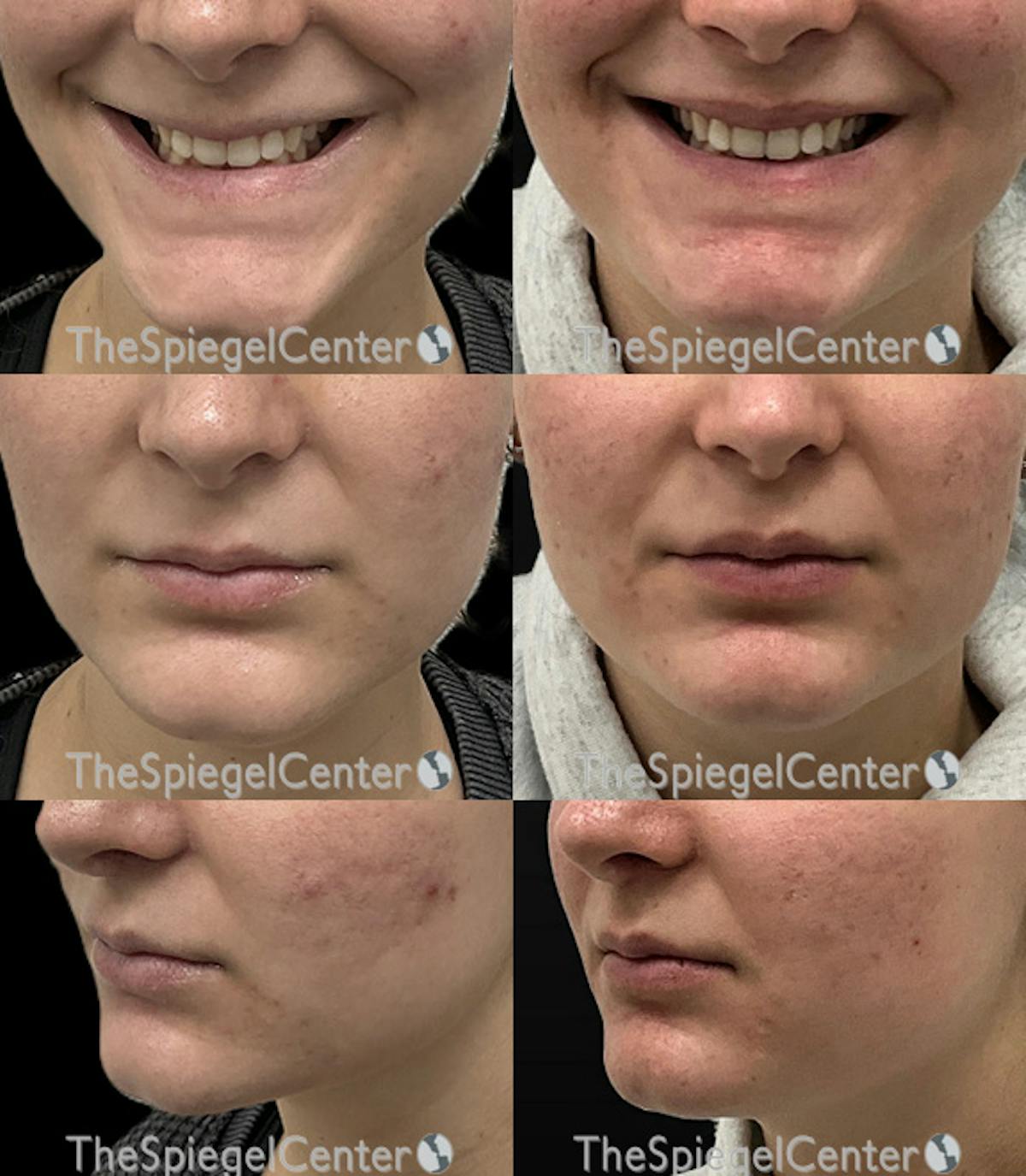 Lip Filler Before & After Gallery - Patient 148415 - Image 1