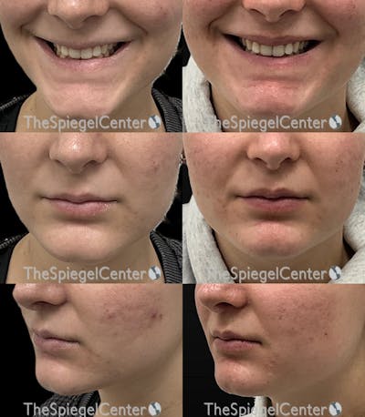 Lip Filler Before & After Gallery - Patient 148415 - Image 1