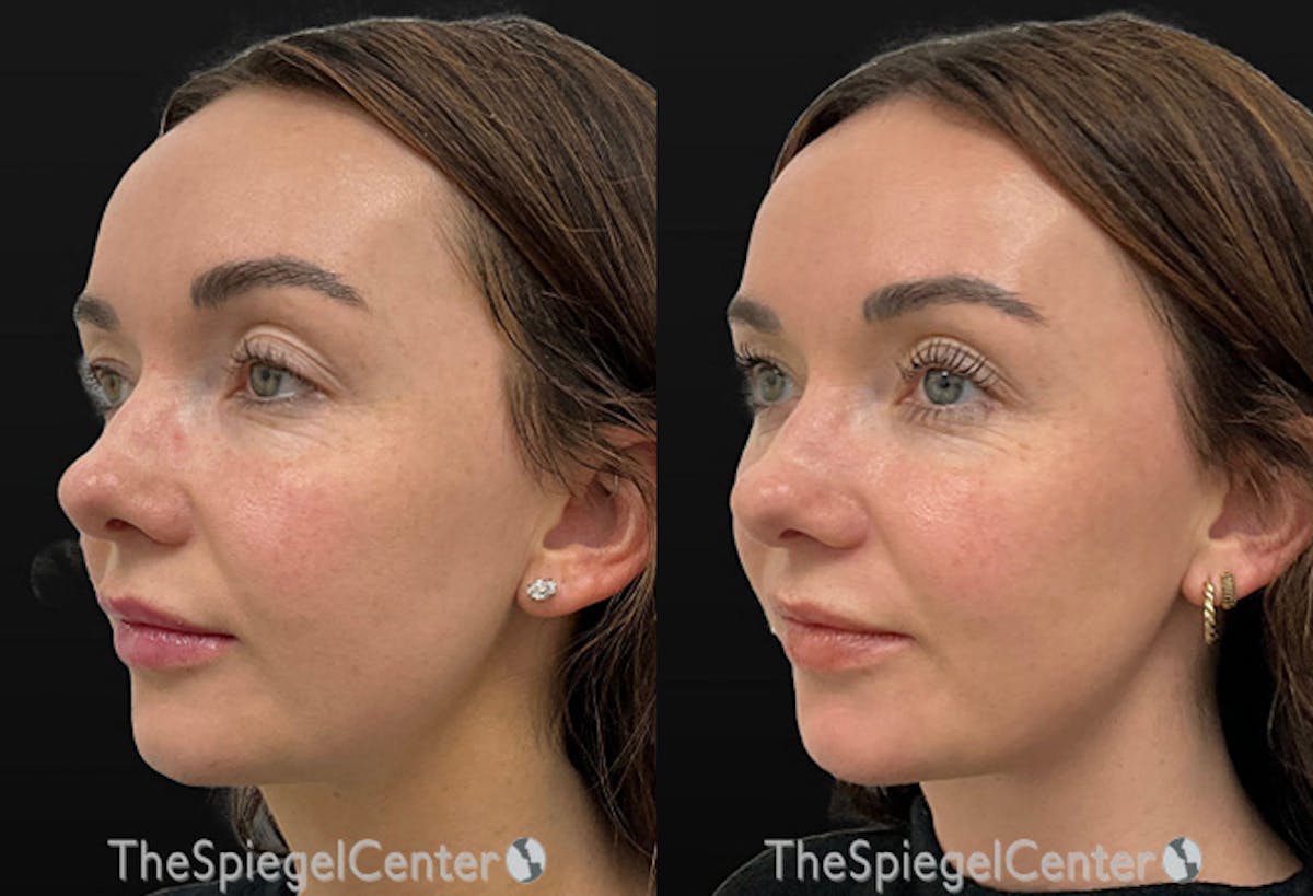 Microneedling Before & After Gallery - Patient 372488 - Image 1