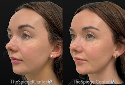 Microneedling Before & After Gallery - Patient 372488 - Image 1