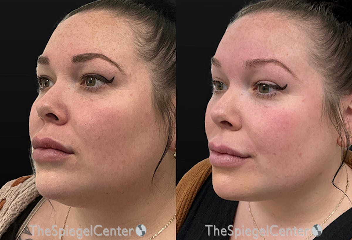 Microneedling Before & After Gallery - Patient 399207 - Image 1