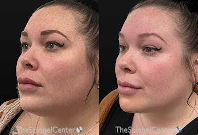 Microneedling Before & After Gallery - Patient 399207 - Image 1