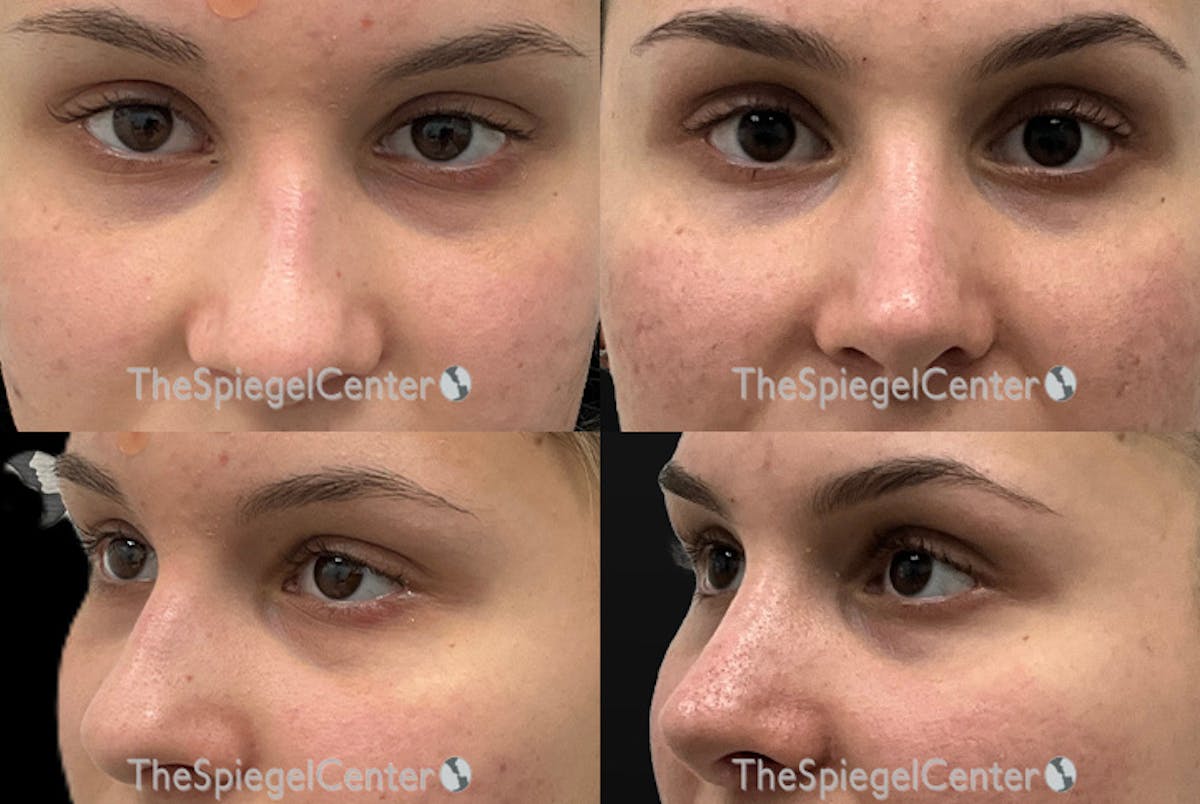 Rhinoplasty Before & After Gallery - Patient 190751 - Image 1