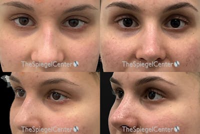 Rhinoplasty Before & After Gallery - Patient 190751 - Image 1