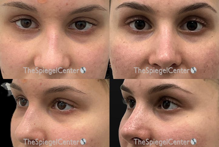 Rhinoplasty Before & After Gallery - Patient 190751 - Image 1