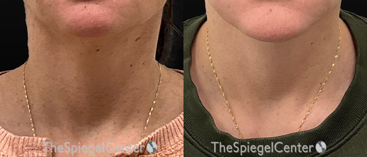 Neck Botox Before & After Gallery - Patient 209675 - Image 1