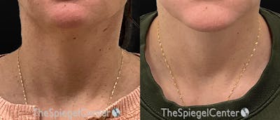 Neck Botox Before & After Gallery - Patient 209675 - Image 1