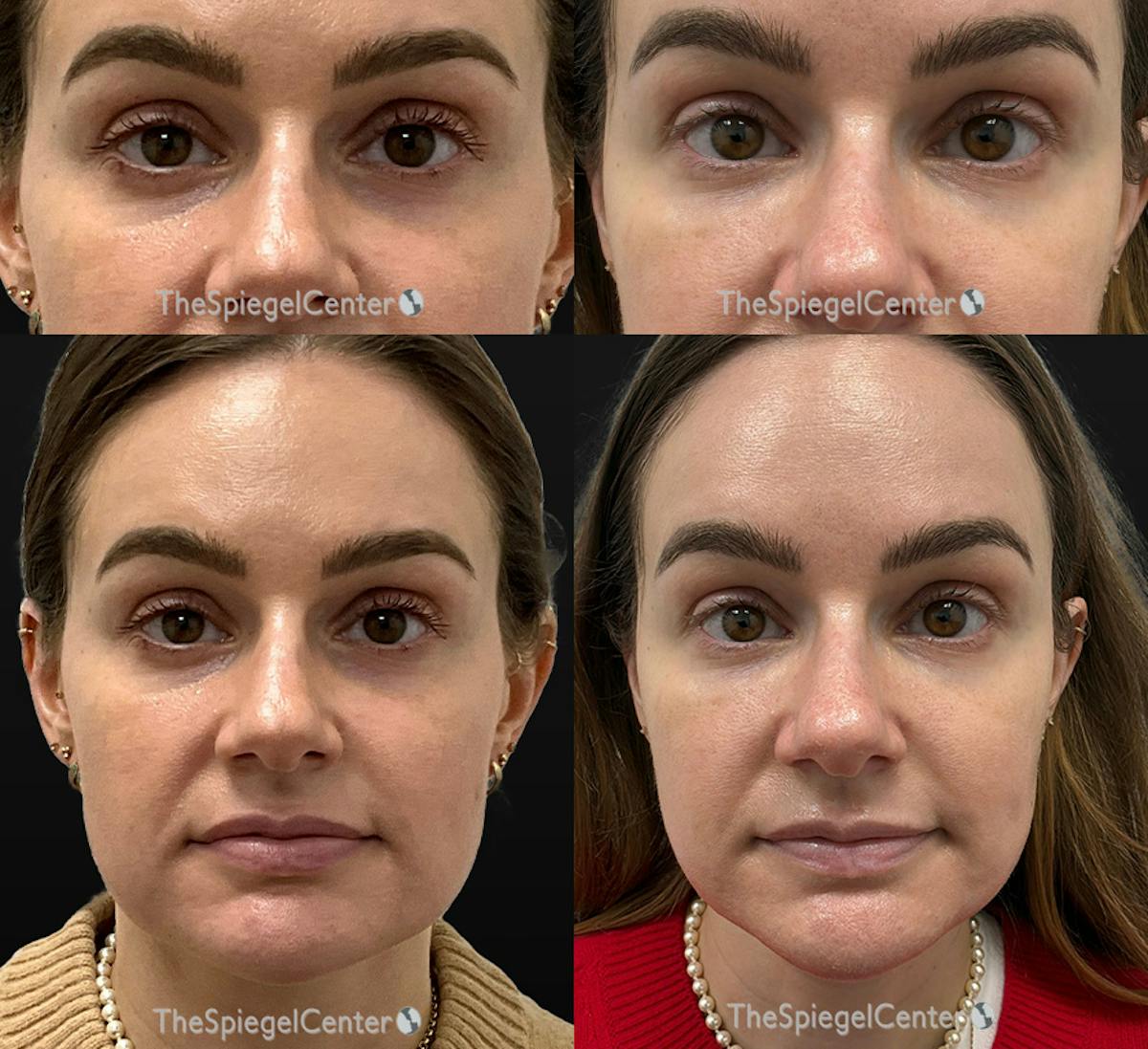 Temple Filler Before & After Gallery - Patient 328644 - Image 1