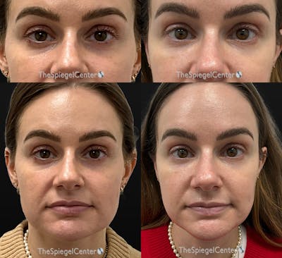 Temple Filler Before & After Gallery - Patient 328644 - Image 1