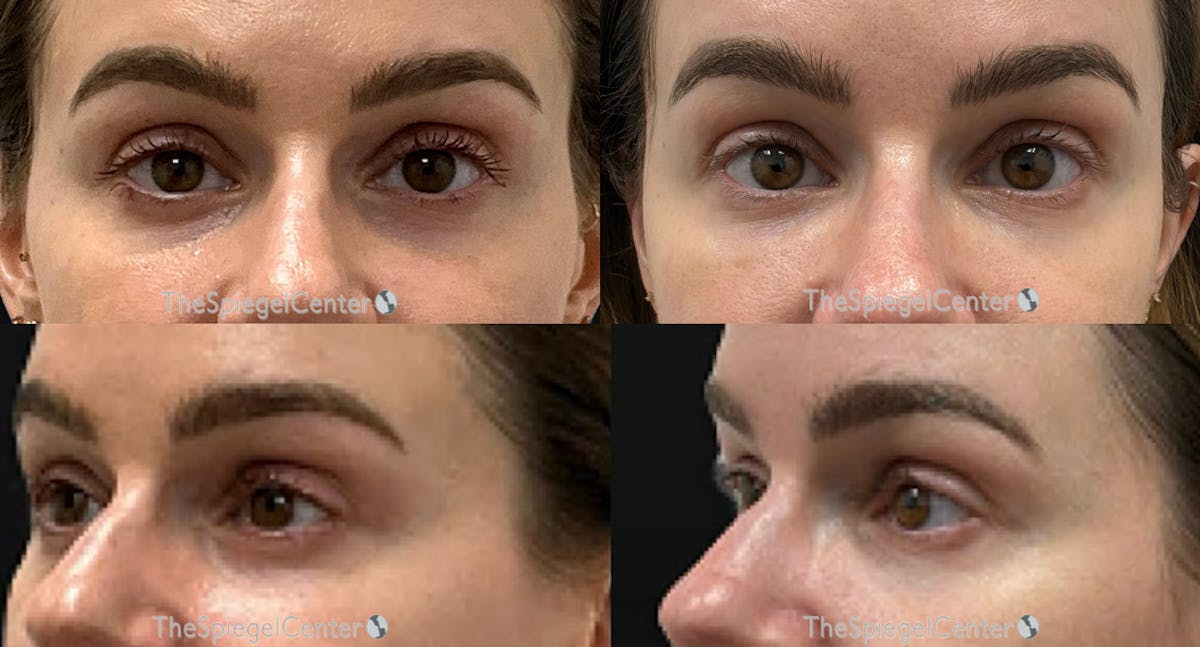Tear Trough / Under Eye Fillers Before & After Gallery - Patient 308978 - Image 1