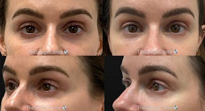 Tear Trough / Under Eye Fillers Before & After Gallery - Patient 308978 - Image 1