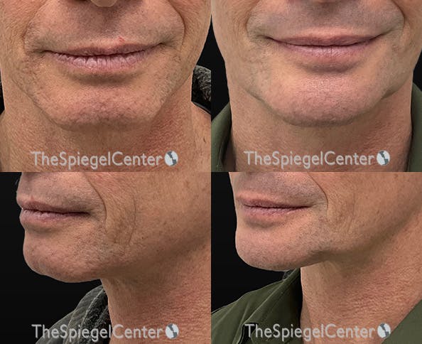 Chin Augmentation Before & After Gallery - Patient 544456 - Image 1