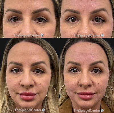 Temple Filler Before & After Gallery - Patient 115948 - Image 1