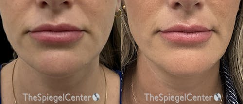 DOA Botulinum Before & After Gallery - Patient 210460 - Image 1