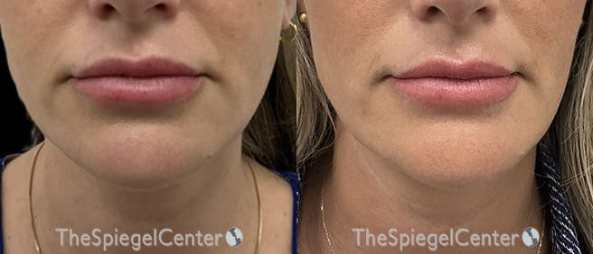 DOA Botulinum Before & After Gallery - Patient 210460 - Image 1