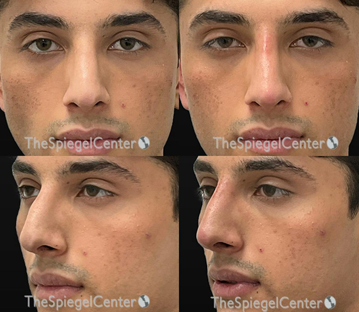 Non-Surgical Rhinoplasty / Nose Filler Before & After Gallery - Patient 132054 - Image 1