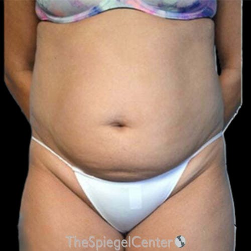 Liposuction Before & After Gallery - Patient 186899 - Image 1