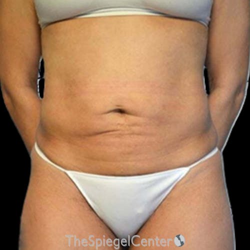 Liposuction Before & After Gallery - Patient 186899 - Image 2