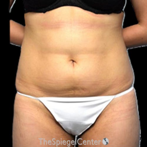 Liposuction Before & After Gallery - Patient 184061 - Image 1