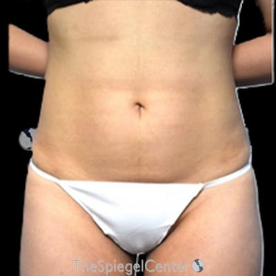 Liposuction Before & After Gallery - Patient 184061 - Image 2