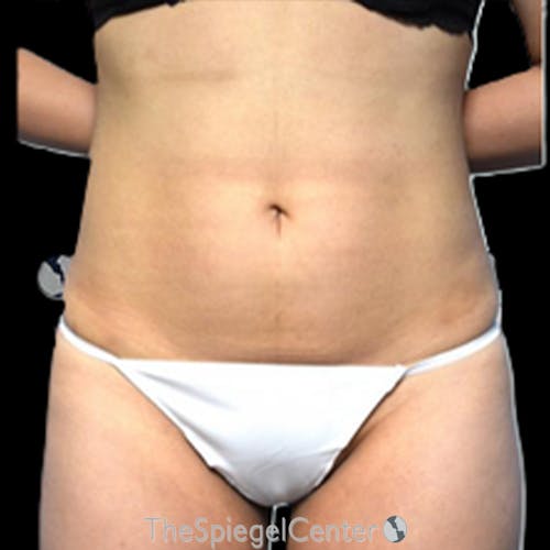Liposuction Before & After Gallery - Patient 184061 - Image 2