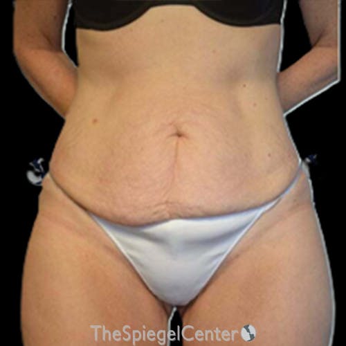 Liposuction Before & After Gallery - Patient 108121 - Image 1