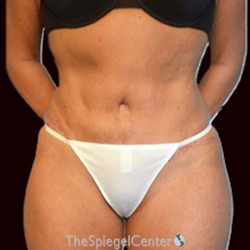 Liposuction Before & After Gallery - Patient 108121 - Image 2