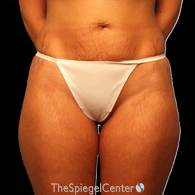 Liposuction Before & After Gallery - Patient 215309 - Image 1