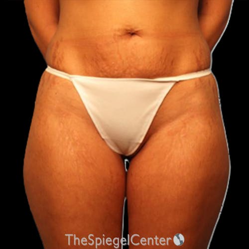 Liposuction Before & After Gallery - Patient 215309 - Image 1