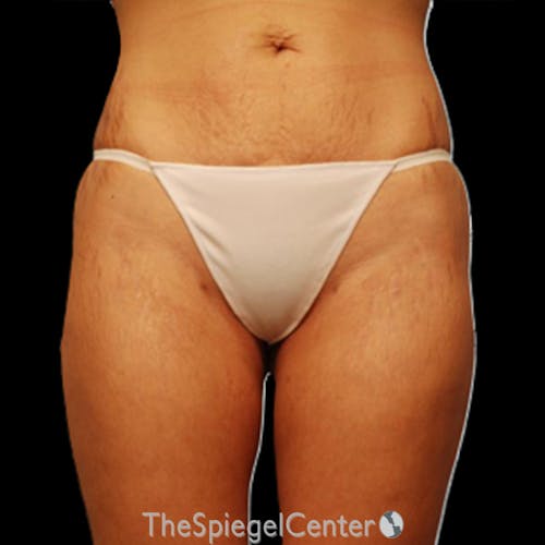 Liposuction Before & After Gallery - Patient 215309 - Image 2