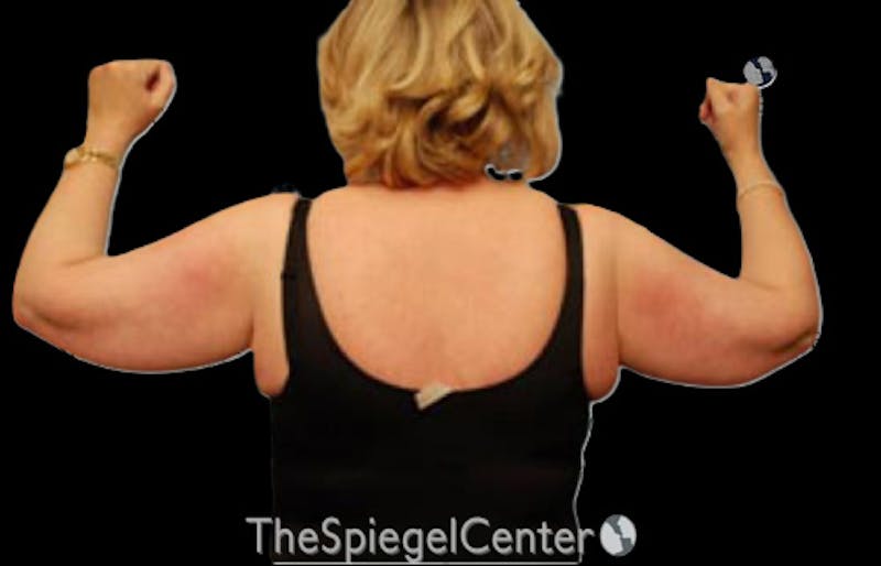 Liposuction Before & After Gallery - Patient 698530 - Image 1