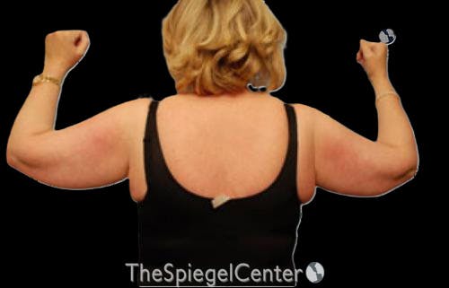 Liposuction Before & After Gallery - Patient 698530 - Image 1
