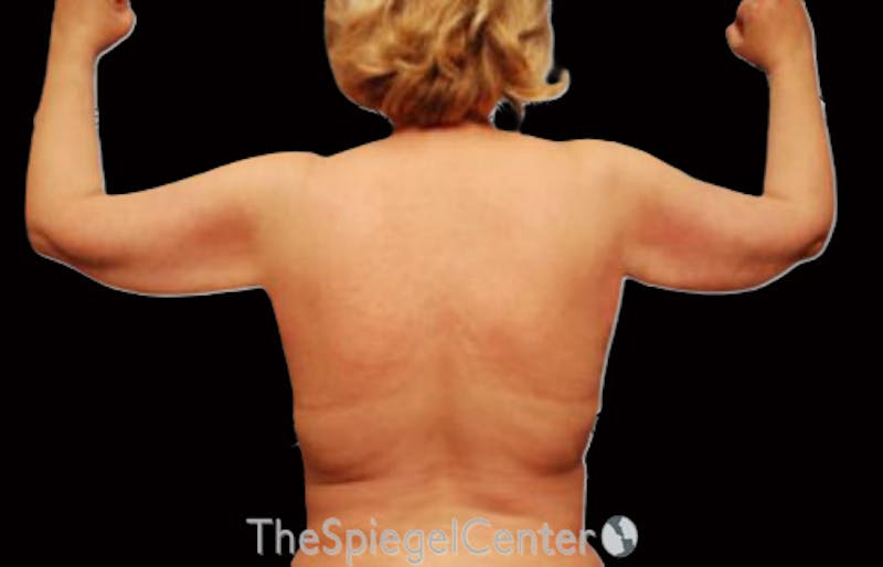 Liposuction Before & After Gallery - Patient 698530 - Image 2