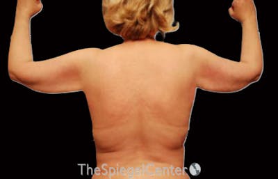 Liposuction Before & After Gallery - Patient 698530 - Image 2