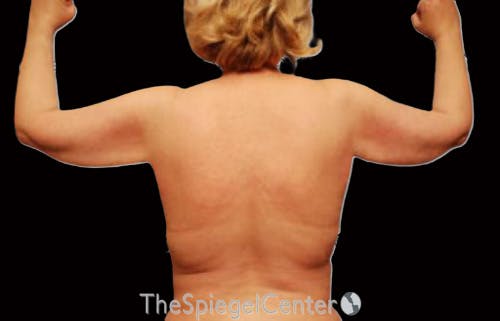 Liposuction Before & After Gallery - Patient 698530 - Image 2