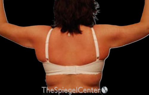 Arm Lift Before & After Gallery - Patient 541703 - Image 2
