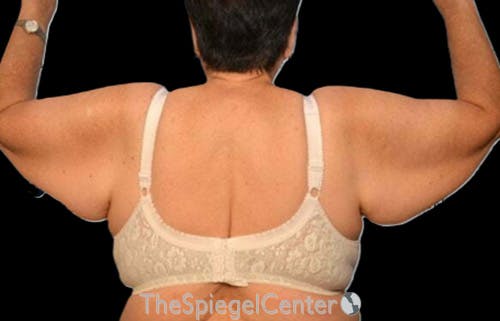 Arm Lift Before & After Gallery - Patient 210510 - Image 1