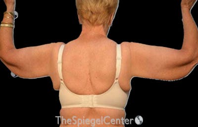Arm Lift Before & After Gallery - Patient 274400 - Image 1