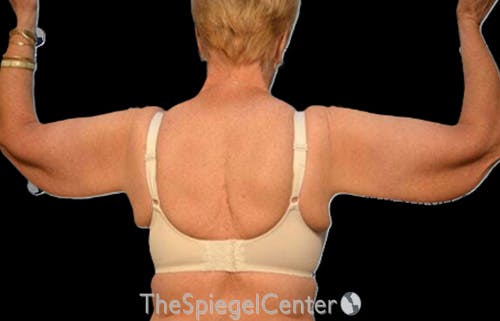 Arm Lift Before & After Gallery - Patient 274400 - Image 1