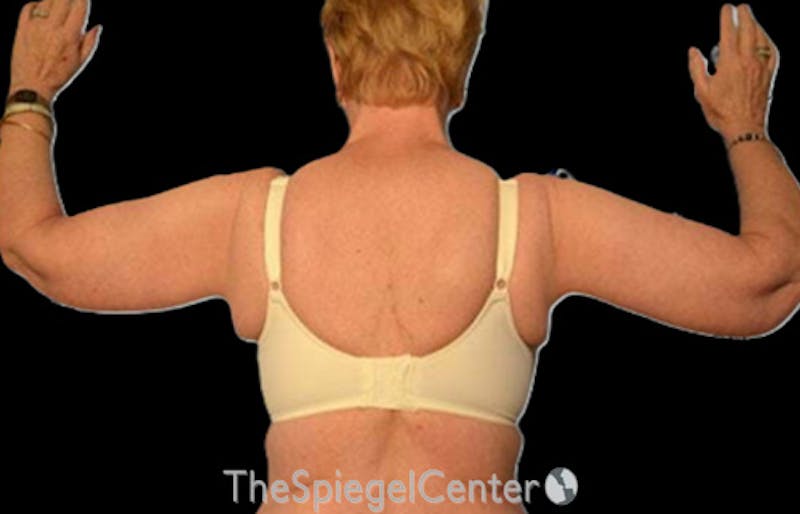 Arm Lift Before & After Gallery - Patient 274400 - Image 2