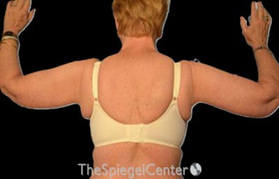 Arm Lift Before & After Gallery - Patient 274400 - Image 2