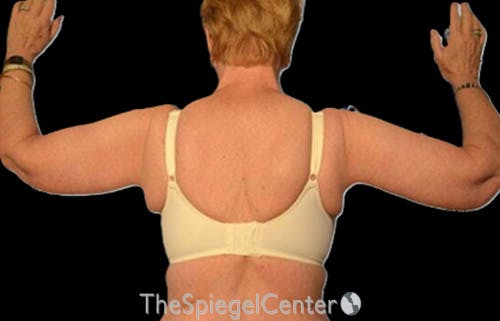Arm Lift Before & After Gallery - Patient 274400 - Image 2