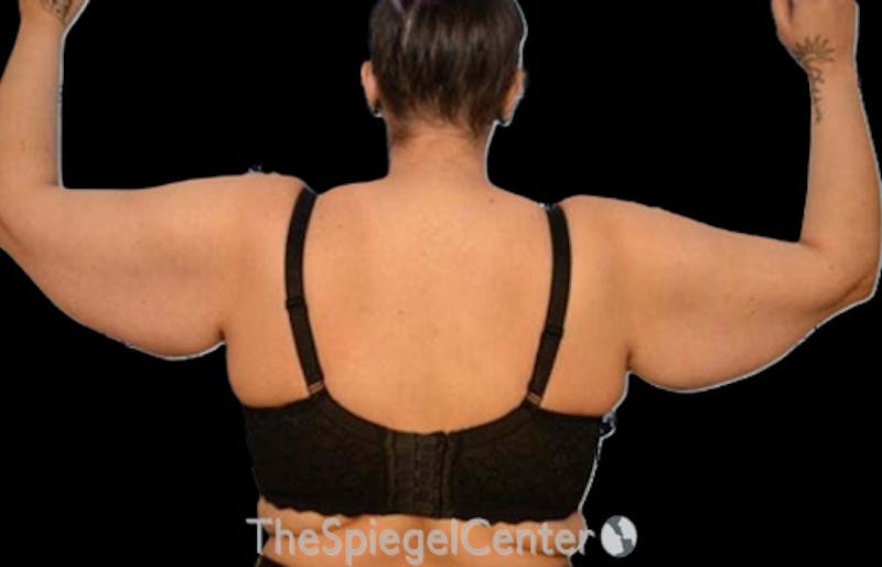 Arm Lift Before & After Gallery - Patient 394712 - Image 1