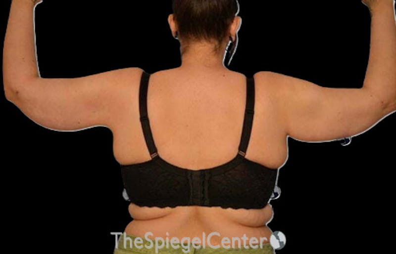 Arm Lift Before & After Gallery - Patient 394712 - Image 2