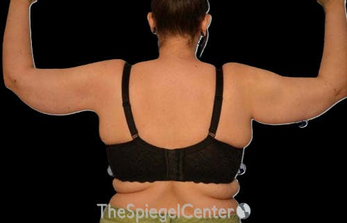 Arm Lift Before & After Gallery - Patient 394712 - Image 2
